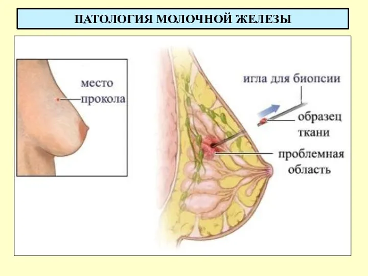 ПАТОЛОГИЯ МОЛОЧНОЙ ЖЕЛЕЗЫ