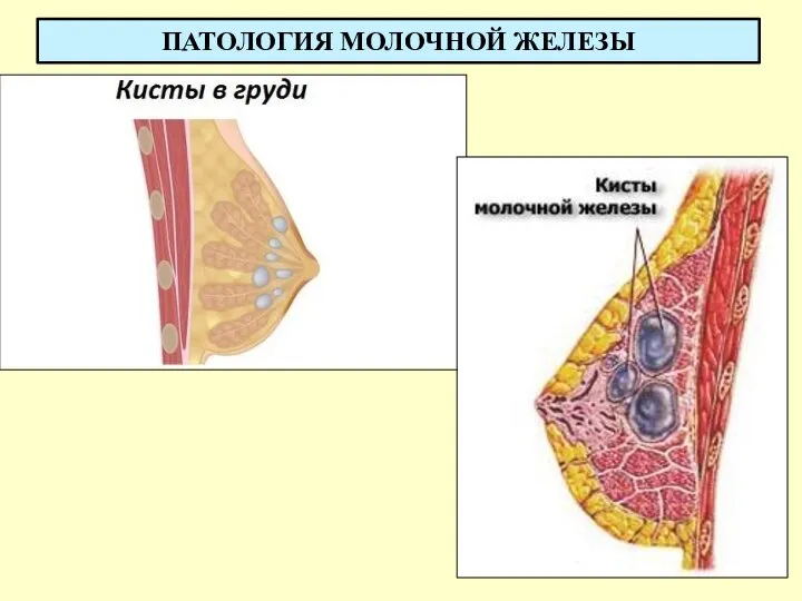 ПАТОЛОГИЯ МОЛОЧНОЙ ЖЕЛЕЗЫ