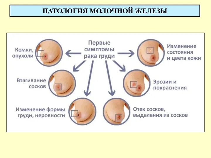 ПАТОЛОГИЯ МОЛОЧНОЙ ЖЕЛЕЗЫ