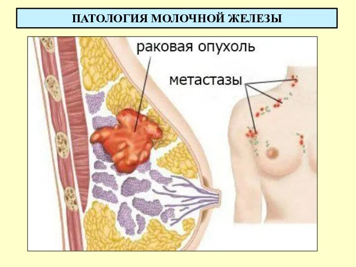 ПАТОЛОГИЯ МОЛОЧНОЙ ЖЕЛЕЗЫ