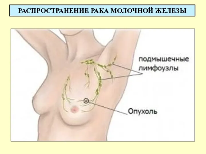 РАСПРОСТРАНЕНИЕ РАКА МОЛОЧНОЙ ЖЕЛЕЗЫ