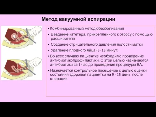 Метод вакуумной аспирации Комбинированный метод обезболивания Введение катетера, прикрепленного к отсосу с