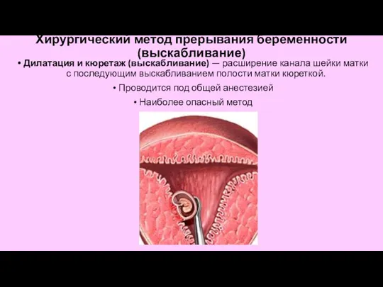 Хирургический метод прерывания беременности (выскабливание) Дилатация и кюретаж (выскабливание) — расширение канала