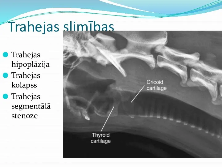 Trahejas slimības Trahejas hipoplāzija Trahejas kolapss Trahejas segmentālā stenoze