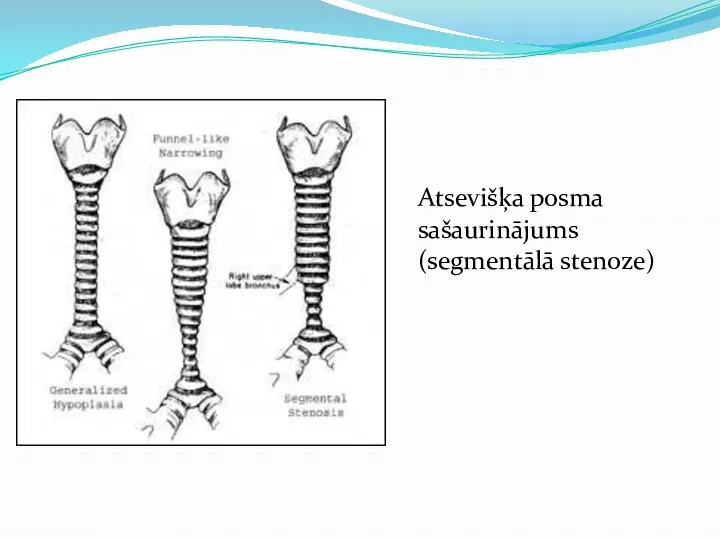 Trahejas stenoze Atsevišķa posma sašaurinājums (segmentālā stenoze)