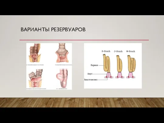 ВАРИАНТЫ РЕЗЕРВУАРОВ