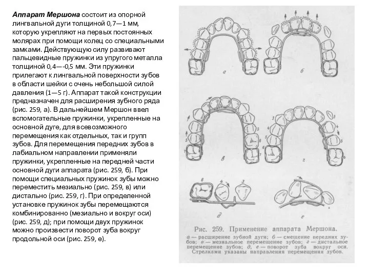 Аппарат Мершона состоит из опорной лингвальной дуги толщиной 0,7—1 мм, которую укрепляют