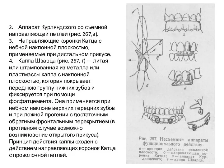 2. Аппарат Курляндского со съемной направляющей петлей (рис. 267,в). 3. Направляющие коронки