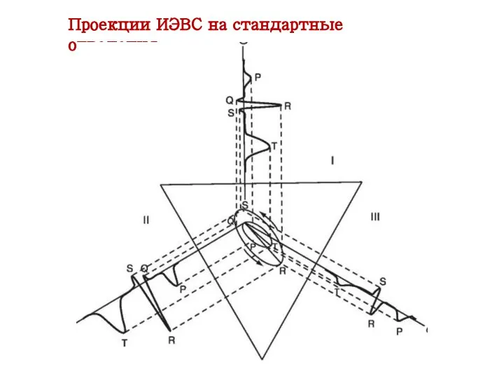 Проекции ИЭВС на стандартные отведения