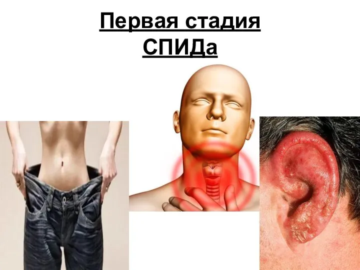 Первая стадия СПИДа