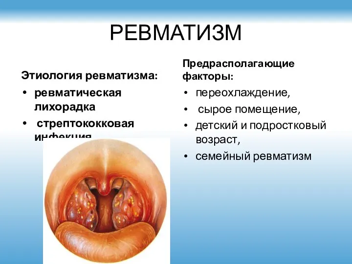 РЕВМАТИЗМ Этиология ревматизма: ревматическая лихорадка стрептококковая инфекция Предрасполагающие факторы: переохлаждение, сырое помещение,