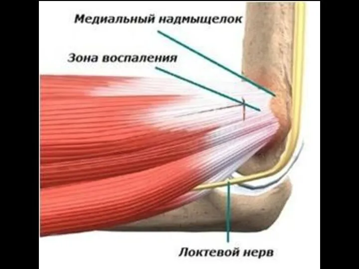 Здоровый сустав Начальные изменения Выраженные изменения Конечная стадия