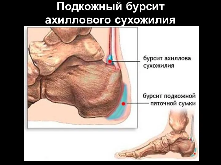 Подкожный бурсит ахиллового сухожилия