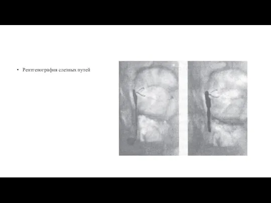 Рентгенография слезных путей