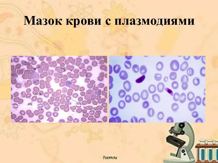 Мазок крови с плазмодиями