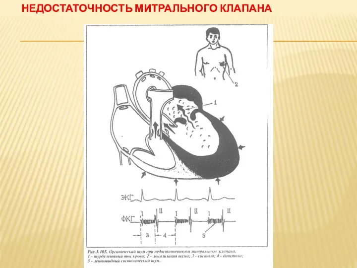 НЕДОСТАТОЧНОСТЬ МИТРАЛЬНОГО КЛАПАНА