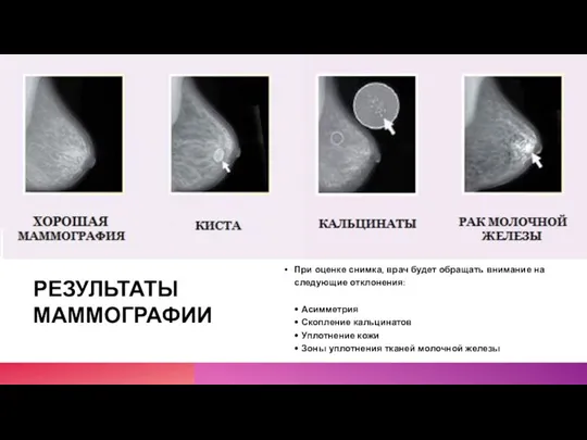 РЕЗУЛЬТАТЫ МАММОГРАФИИ При оценке снимка, врач будет обращать внимание на следующие отклонения: