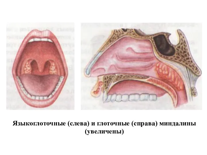 Языкоглоточные (слева) и глоточные (справа) миндалины (увеличены)