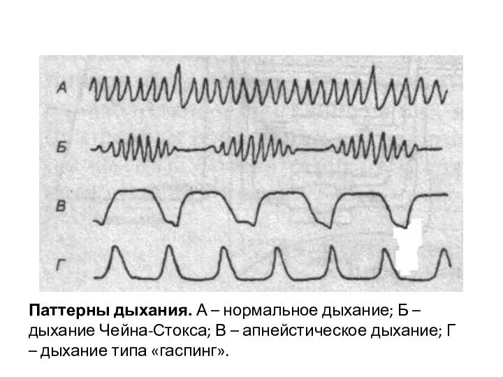 Паттерны дыхания. А – нормальное дыхание; Б – дыхание Чейна-Стокса; В –