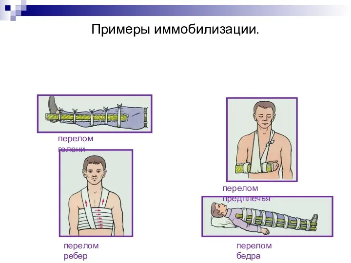 Примеры иммобилизации. перелом ребер перелом голени перелом предплечья перелом бедра