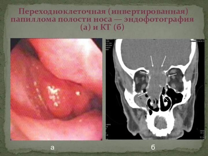 Переходноклеточная (инвертированная) папиллома полости носа — эндофотография (а) и КТ (б) а б