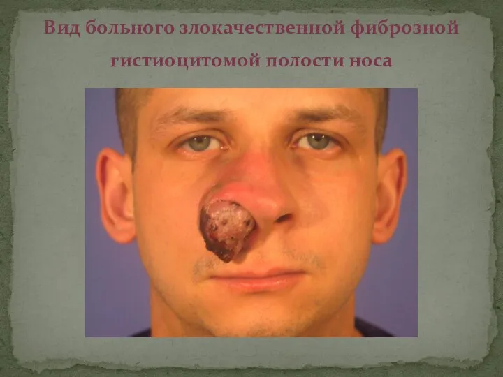 Вид больного злокачественной фиброзной гистиоцитомой полости носа