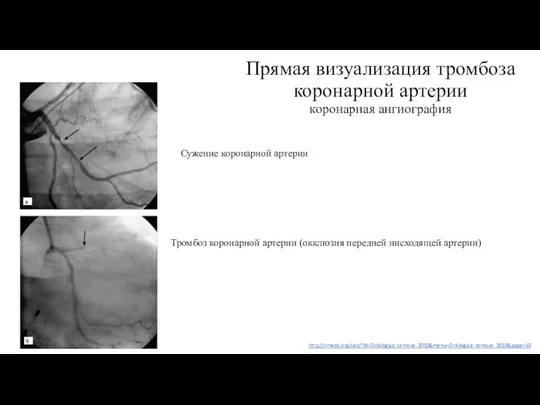 Прямая визуализация тромбоза коронарной артерии коронарная ангиография Сужение коронарной артерии Тромбоз коронарной