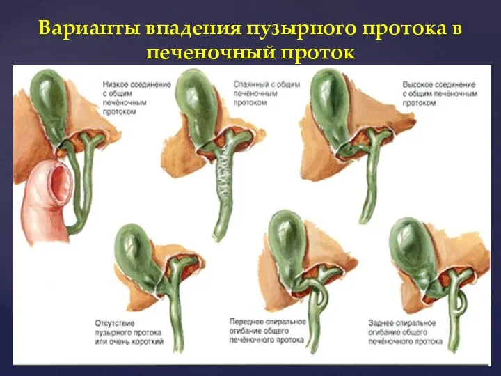 Варианты впадения пузырного протока в печеночный проток