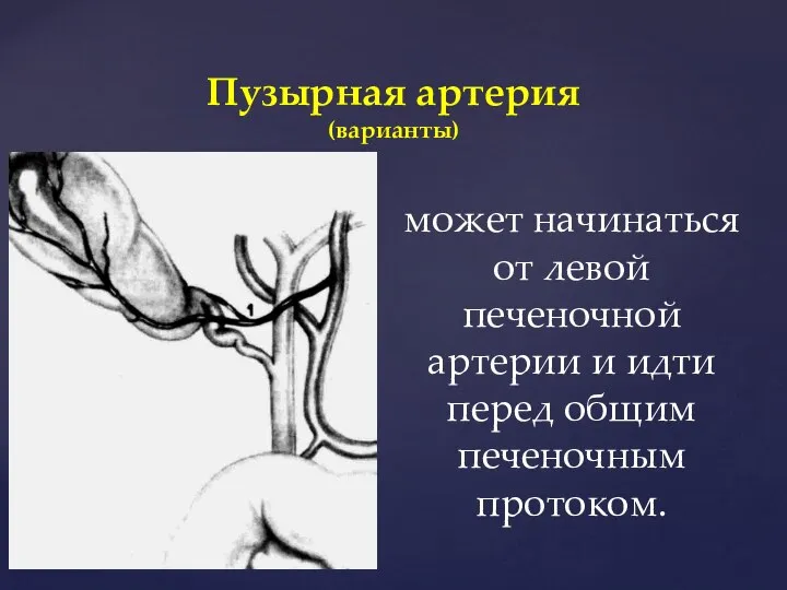 Пузырная артерия (варианты) может начинаться от левой печеночной артерии и идти перед общим печеночным протоком.