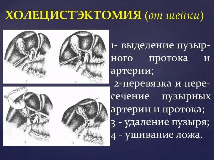 ХОЛЕЦИСТЭКТОМИЯ (от шейки) 1- выделение пузыр-ного протока и артерии; 2-перевязка и пере-сечение