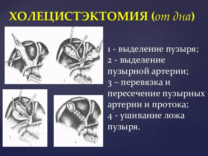 ХОЛЕЦИСТЭКТОМИЯ (от дна) 1 - выделение пузыря; 2 - выделение пузырной артерии;