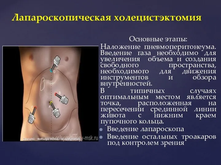 Основные этапы: Наложение пневмоперитонеума. Введение газа необходимо для увеличения объема и создания