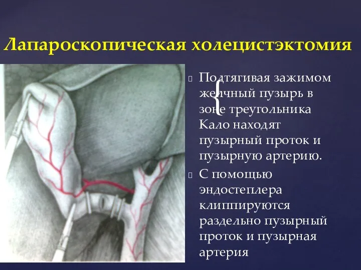 Подтягивая зажимом желчный пузырь в зоне треугольника Кало находят пузырный проток и