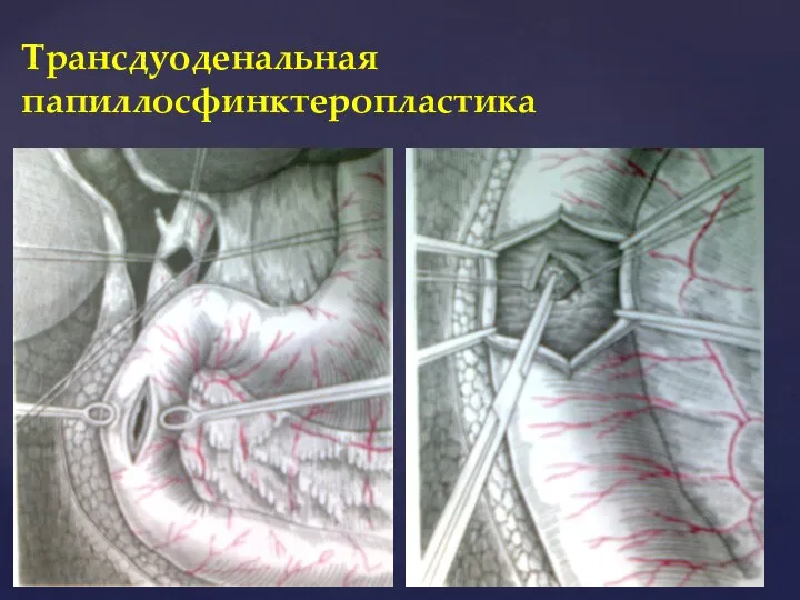 Трансдуоденальная папиллосфинктеропластика