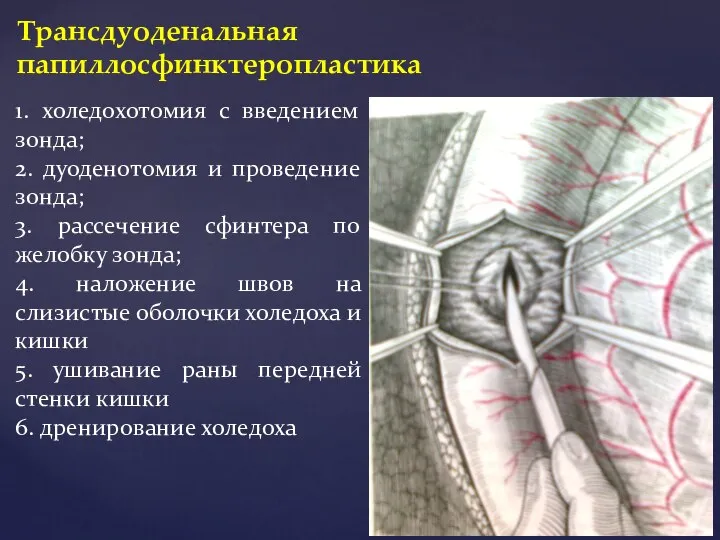 Трансдуоденальная папиллосфинктеропластика 1. холедохотомия с введением зонда; 2. дуоденотомия и проведение зонда;