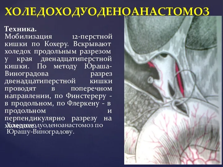 Холедоходуоденоанастомоз по Юрашу-Виноградову. ХОЛЕДОХОДУОДЕНОАНАСТОМОЗ Техника. Мобилизация 12-перстной кишки по Кохеру. Вскрывают холедох