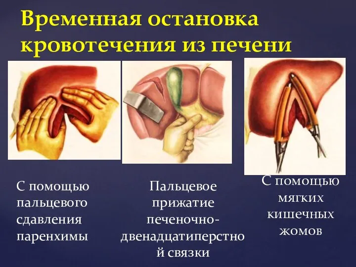 С помощью мягких кишечных жомов Временная остановка кровотечения из печени С помощью