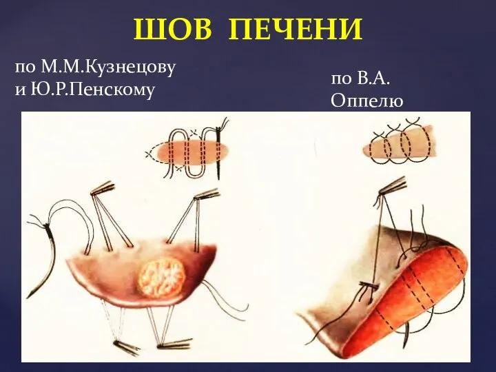 ШОВ ПЕЧЕНИ по В.А.Оппелю по М.М.Кузнецову и Ю.Р.Пенскому