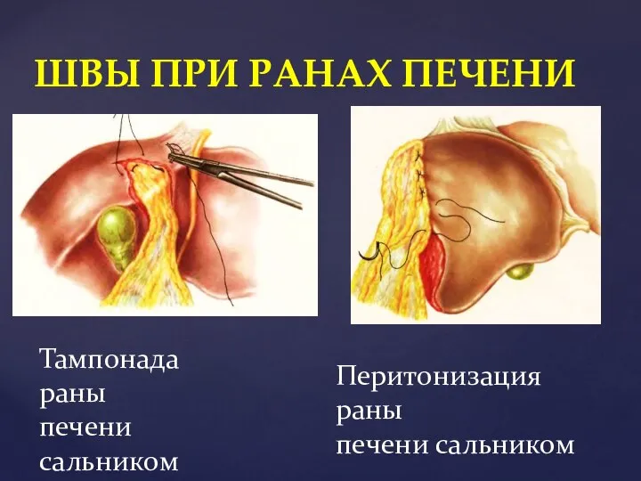 ШВЫ ПРИ РАНАХ ПЕЧЕНИ Тампонада раны печени сальником Перитонизация раны печени сальником