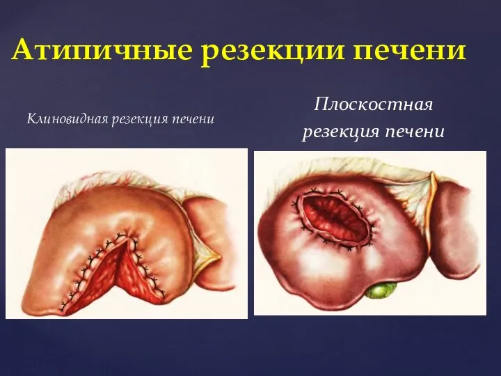 Клиновидная резекция печени Атипичные резекции печени Плоскостная резекция печени