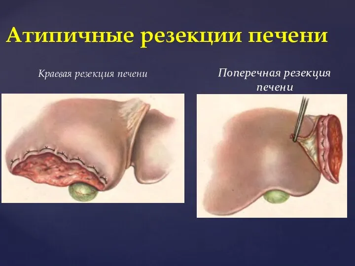 Краевая резекция печени Атипичные резекции печени Поперечная резекция печени