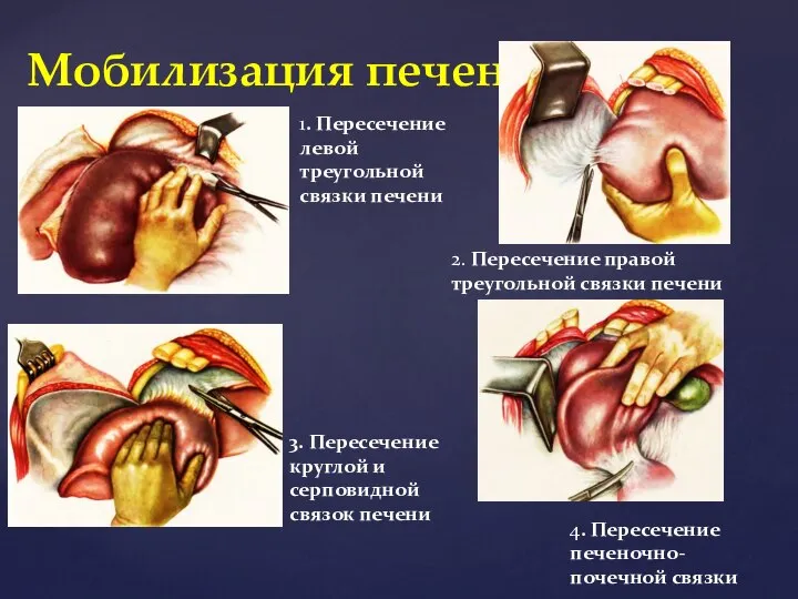 Мобилизация печени 1. Пересечение левой треугольной связки печени 2. Пересечение правой треугольной