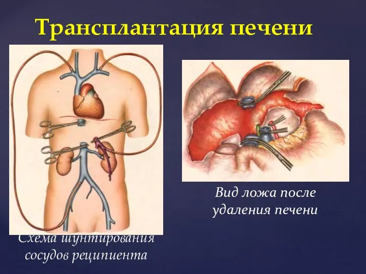 Схема шунтирования сосудов реципиента Трансплантация печени Вид ложа после удаления печени