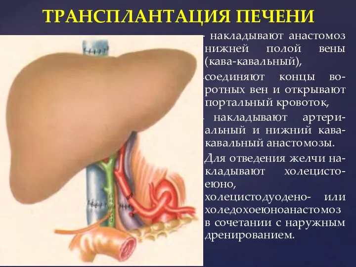 - накладывают анастомоз нижней полой вены (кава-кавальный), соединяют концы во-ротных вен и