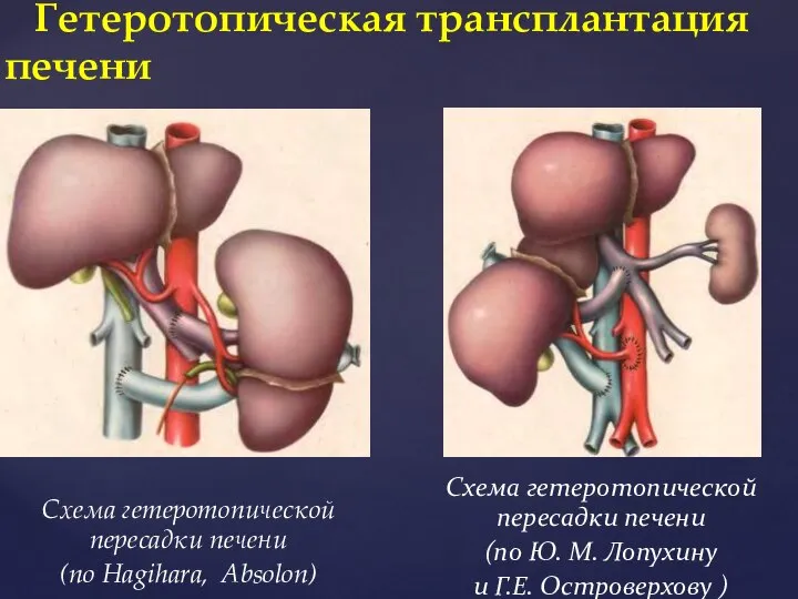 Схема гетеротопической пересадки печени (по Hagihara, Absolon) Гетеротопическая трансплантация печени Схема гетеротопической