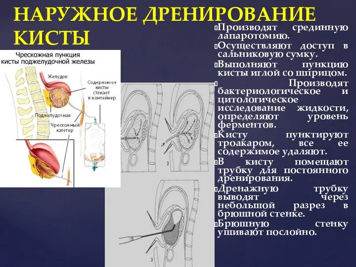 НАРУЖНОЕ ДРЕНИРОВАНИЕ КИСТЫ Производят срединную лапаротомию. Осуществляют доступ в сальниковую сумку. Выполняют