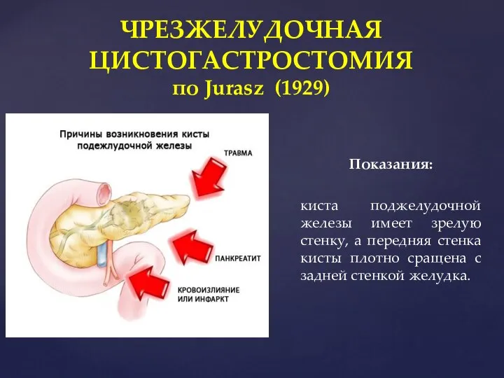 Показания: киста поджелудочной железы имеет зрелую стенку, а передняя стенка кисты плотно