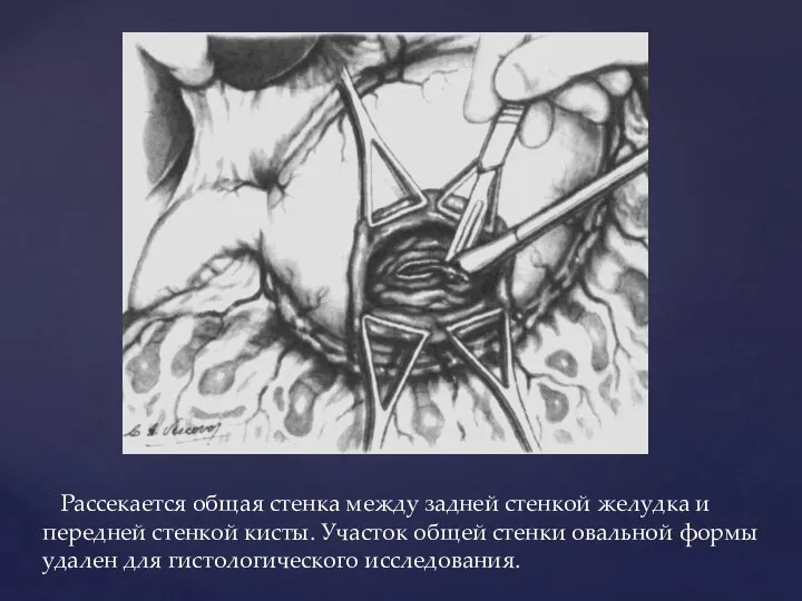 Рассекается общая стенка между задней стенкой желудка и передней стенкой кисты. Участок