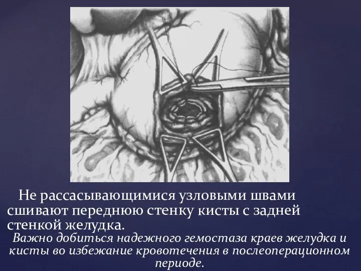 Не рассасывающимися узловыми швами сшивают переднюю стенку кисты с задней стенкой желудка.