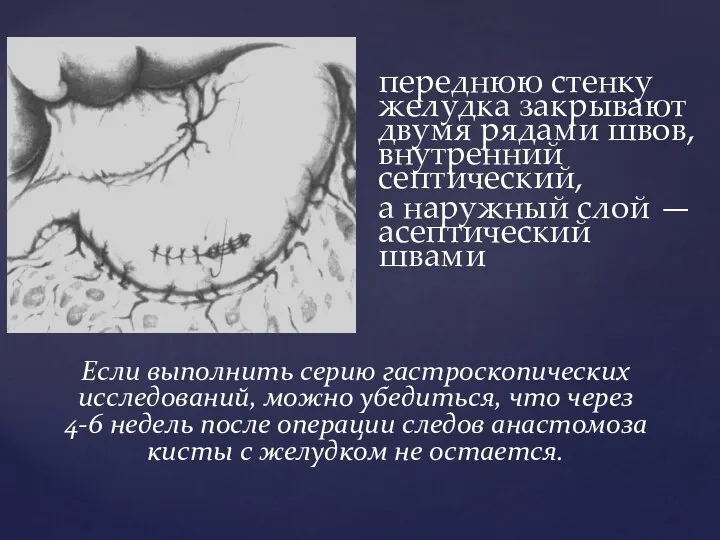 переднюю стенку желудка закрывают двумя рядами швов, внутренний септический, а наружный слой